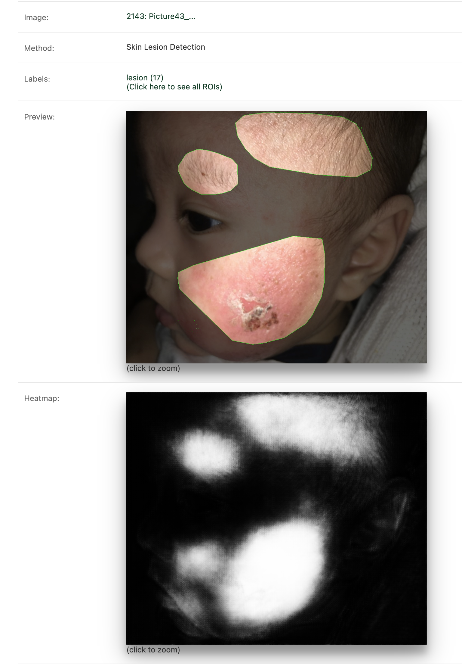 Automated Lesion Detection